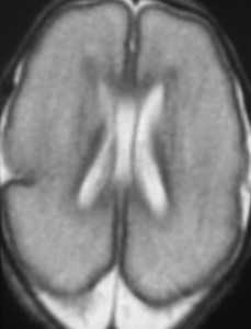 brain infant cervello neonato