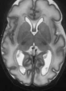 infant brain cervello neonato