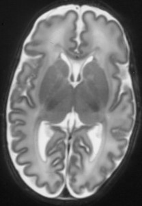 infant brain cervello neonato
